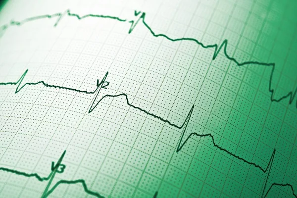 Primer Plano Electrocardiograma Forma Papel —  Fotos de Stock