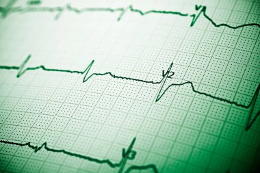 Elektrokardiyogramı kağıt formunda kapat.