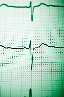 Elektrokardiyogramı kağıt formunda kapat.