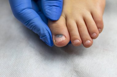 Mavi eldivenli bir doktor çocuğun ayak parmağını muayene ediyor. yakın plan