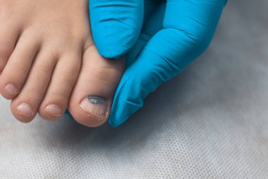 Mavi eldivenli bir doktor çocuğun ayak parmağını muayene ediyor. yakın plan
