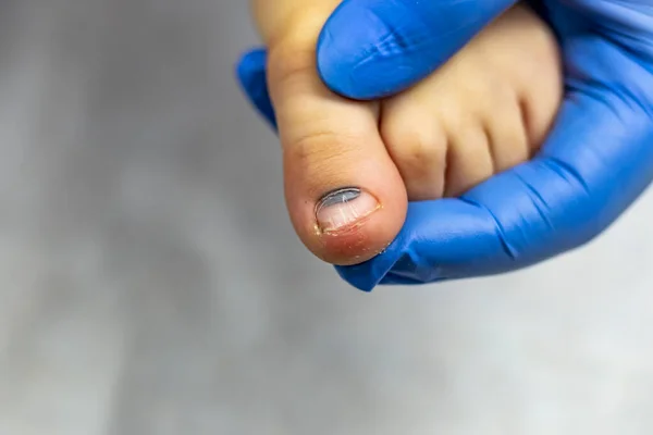 Ένας γιατρός με μπλε γάντι εξετάζει ένα παιδικό δάχτυλο. κοντινό πλάνο — Φωτογραφία Αρχείου