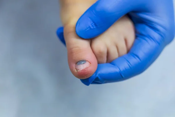 Лікар у блакитній рукавичці вивчає дитячий палець. крупним планом — стокове фото
