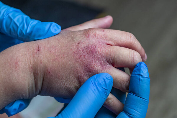 the doctor in blue gloves examines the children's hand. there is redness and dryness on it. she is painful.