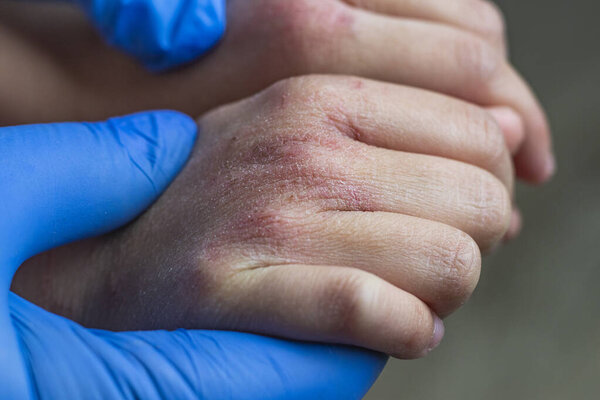 the doctor in blue gloves examines the children's hand. there is redness and dryness on it. she is painful.