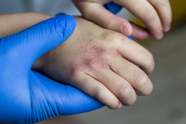 Ο γιατρός με τα μπλε γάντια εξετάζει το χέρι των παιδιών. υπάρχει ερυθρότητα και ξηρότητα σε αυτό. Είναι οδυνηρή.. — Φωτογραφία Αρχείου