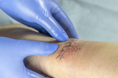 Mavi eldivenli bir doktor bacağındaki yarayı inceliyor. Kesilmiş ve dikilmiş iplikler var..