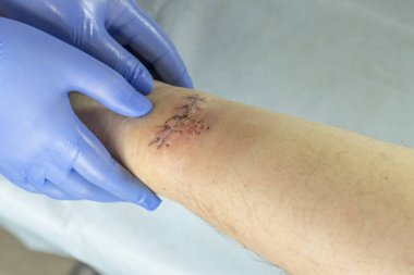 Mavi eldivenli bir doktor bacağındaki yarayı inceliyor. Kesilmiş ve dikilmiş iplikler var..