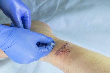 Mavi eldivenli bir doktor bacağındaki yarayı inceliyor. Bir şırınga ile enjeksiyon yapar..