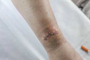 Mavi eldivenli bir doktor bacağındaki yarayı inceliyor. Kesilmiş ve dikilmiş iplikler var..