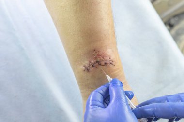 Mavi eldivenli bir doktor bacağındaki yarayı inceliyor. Bir şırınga ile enjeksiyon yapar..