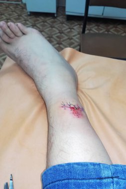 Mavi eldivenli bir doktor bacağındaki yarayı inceliyor. Sargı bezi koyuyor. Hastanın bacağında bandaj var..