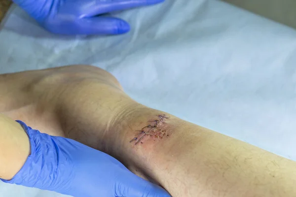 Ένας γιατρός με μπλε γάντια εξετάζει μια πληγή στο πόδι του. υπάρχει ένα κόψιμο και ραμμένο με κλωστές. — Φωτογραφία Αρχείου