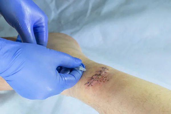 Ένας γιατρός με μπλε γάντια εξετάζει μια πληγή στο πόδι του. κάνει μια ένεση με μια σύριγγα. — Φωτογραφία Αρχείου