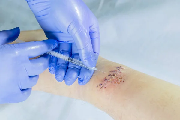 Een arts met blauwe handschoenen onderzoekt een wond aan zijn been. maakt een injectie met een spuit. — Stockfoto