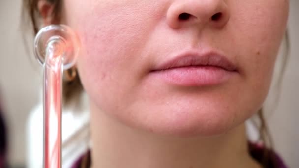 Jong meisje met problemen huid puistjes, acne, roodheid van de huid, maakt microstroom therapie cauteriseert huiduitslag en acne. Cosmetische ingrepen in de gezichtsclose-up — Stockvideo