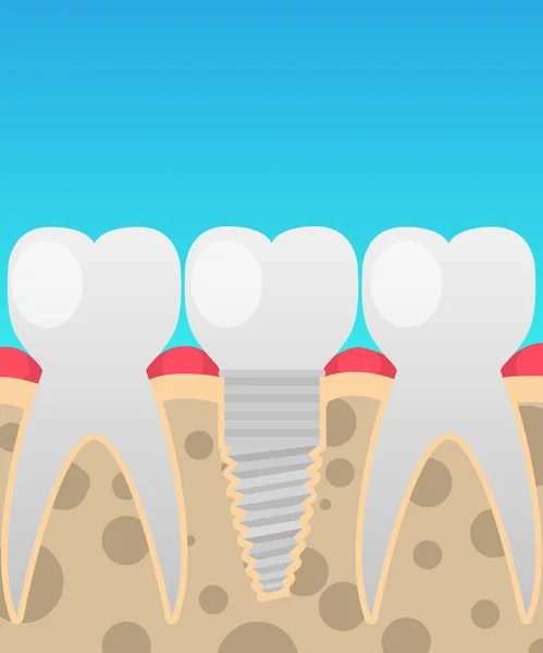 Implantes dentales, reemplazo dental, ilustración vectorial en un estilo plano de dibujos animados aislado sobre el tema de la odontología para sus proyectos — Archivo Imágenes Vectoriales