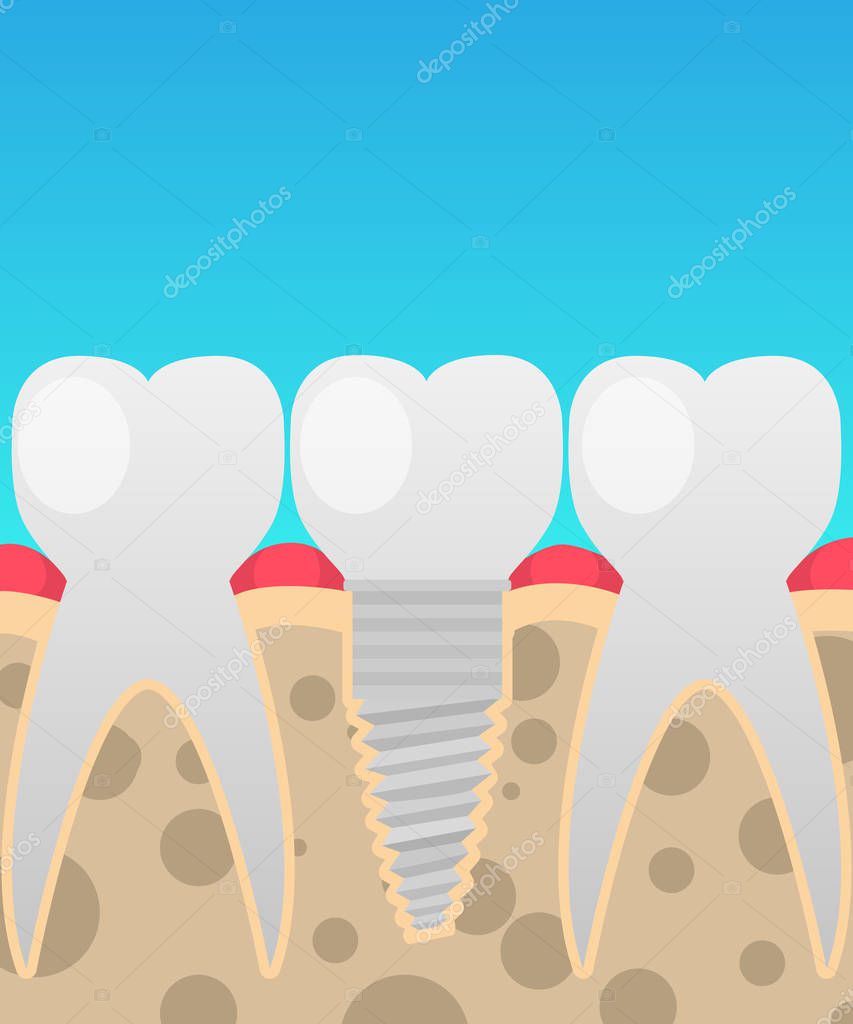 Dental implants, tooth replacement, vector illustration in a cartoon flat style insulated on the topic of dentistry for your projects