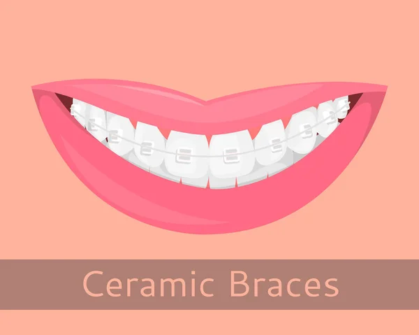 Tandheelkundige accolades, glimlachende lippen in cartoon stijl geïsoleerd. Glimlach met bretels, afbeelding op het onderwerp van stomatologie, orthodontie, tanden alignment, beet de correctie, vector illustratie — Stockvector