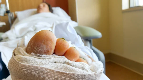 Vrouw in het ziekenhuis met bilaterale enkelfracturen die slapen na — Stockfoto