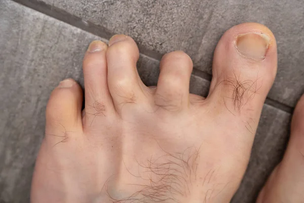 Hombres dedos de martillo antes de la cirugía —  Fotos de Stock