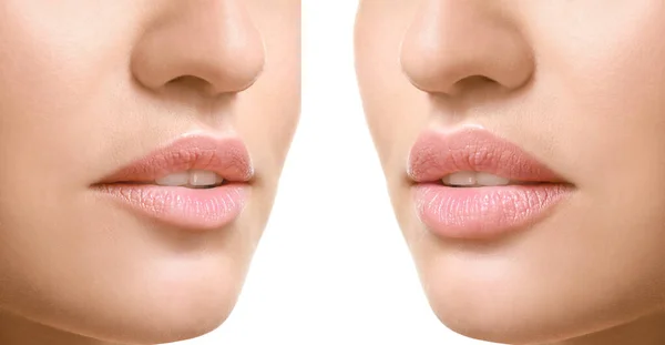 Young woman before and after lip enhancement on white background, closeup — Stock Photo, Image