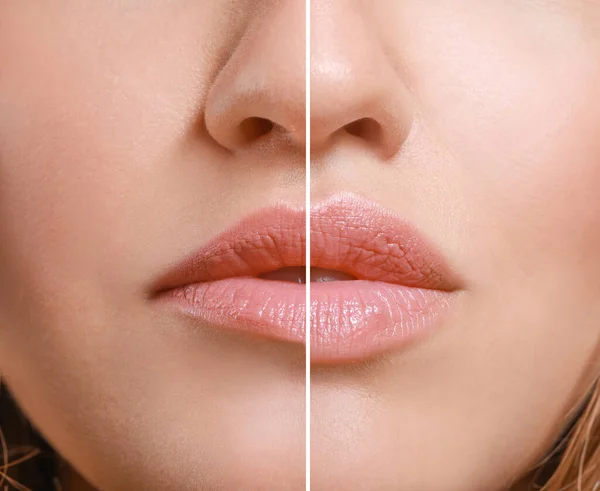 Mujer joven antes y después del realce de labios, primer plano —  Fotos de Stock