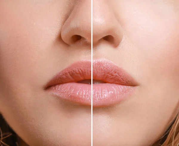 Young woman before and after lip enhancement, closeup — Stock Photo, Image