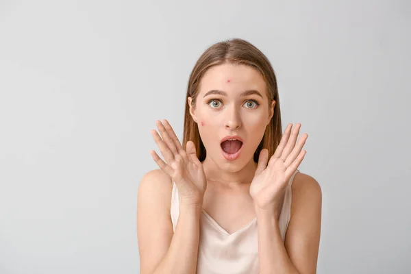 Portret van gestresste jonge vrouw met acne probleem op lichte achtergrond — Stockfoto