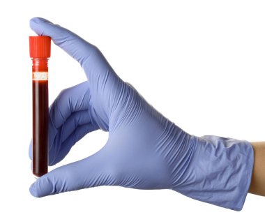 Doktorun eli beyaz arka planda kan olan test tüpünü tutuyor.