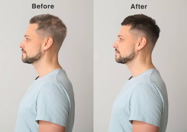 Gri arkaplanda saç dökülmesi öncesi ve sonrası tedavi