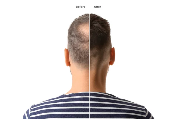 L'uomo prima e dopo il trattamento di perdita dei capelli su sfondo bianco — Foto Stock