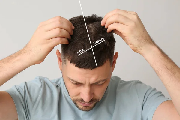 Man before and after hair loss treatment on grey background