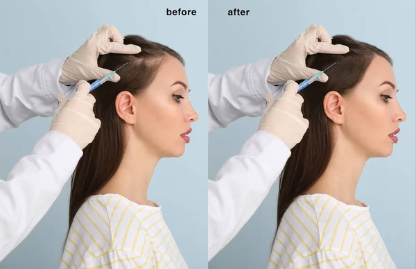 Woman before and after hair loss treatment on color background — Stock Photo, Image