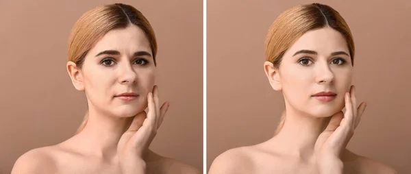 Comparison portrait of woman before and after filler injection on color background — Stock Photo, Image