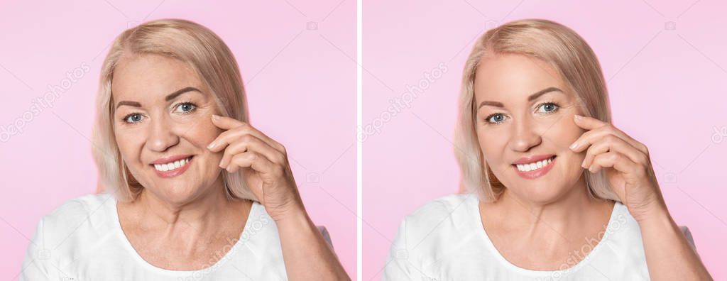 Comparison portrait of mature woman before and after filler injection on color background