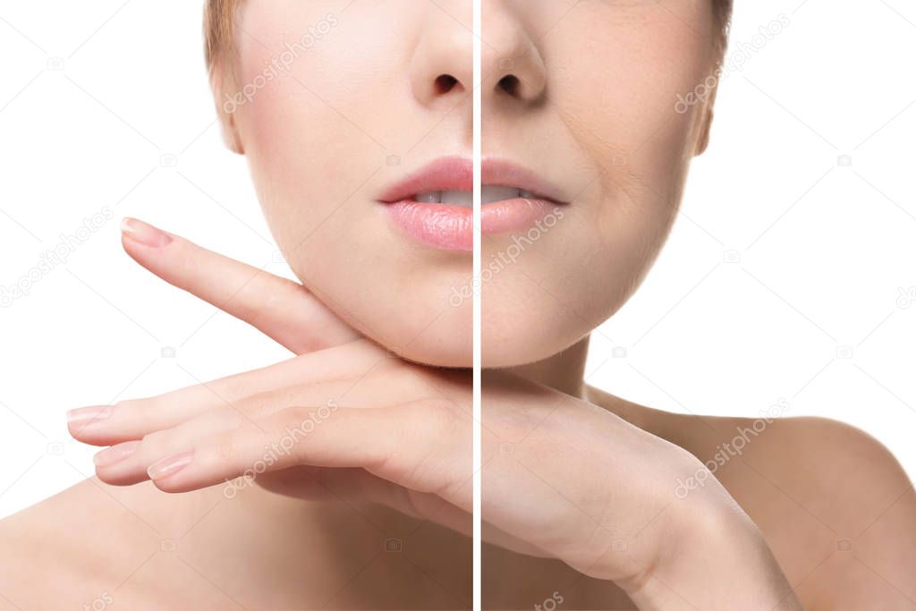 Young woman after and before filler injection on white background