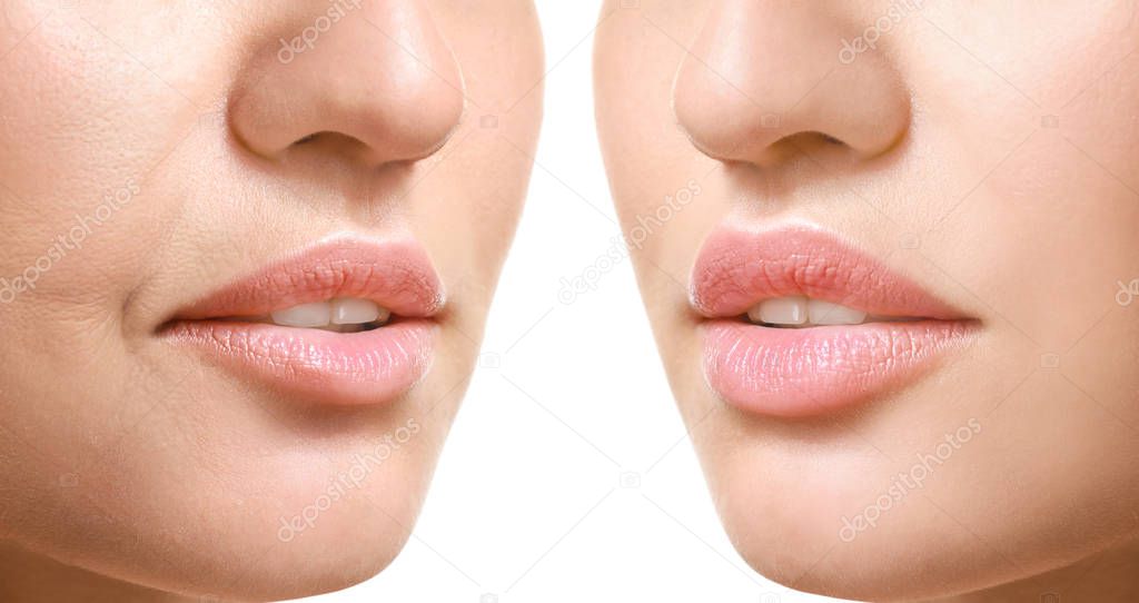 Young woman before and after filler injection on white background