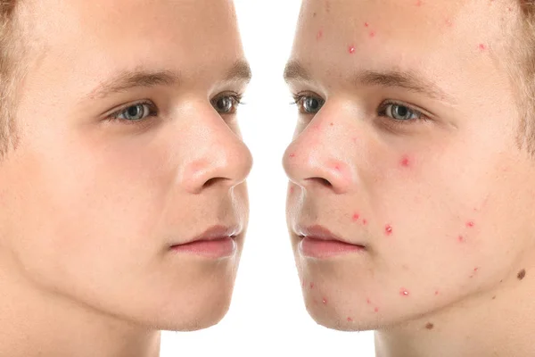 Tiener jongen zonder en met acne op witte achtergrond — Stockfoto