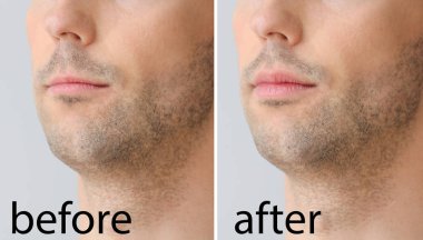 Plastik ameliyattan önce ve sonra arka planda genç adam, yakın plan