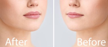 Plastik ameliyattan önce ve sonra arka planda genç bayan, yakın plan.