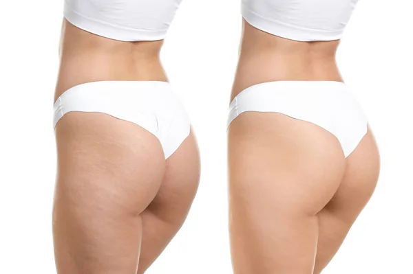 Ung kvinne før og etter plastisk operasjon på hvit bakgrunn – stockfoto