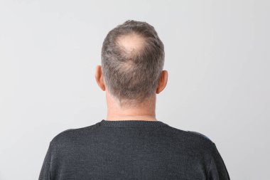 Arka planda saç dökülme sorunu olan son sınıf öğrencisi.