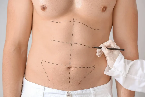 男性の体にマーキングを適用する整形外科医 クローズアップ — ストック写真