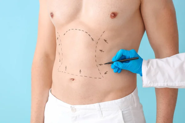 Plastic Surgeon Applying Marking Male Body Color Background — Stock Photo, Image