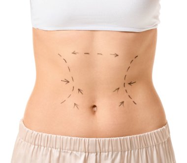 Vücudunda beyaz arka planda izler olan genç bir kadın. Estetik ameliyat kavramı