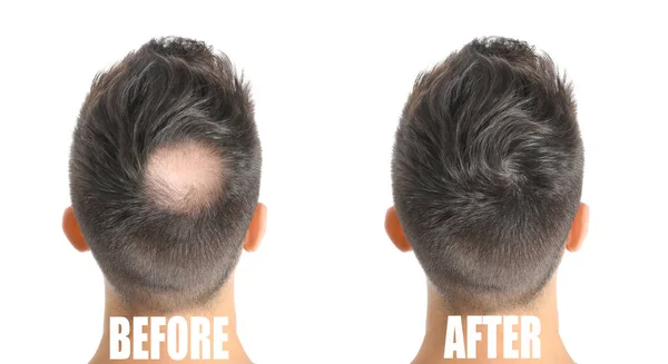 Hombre Antes Después Del Tratamiento Pérdida Cabello Sobre Fondo Blanco —  Fotos de Stock