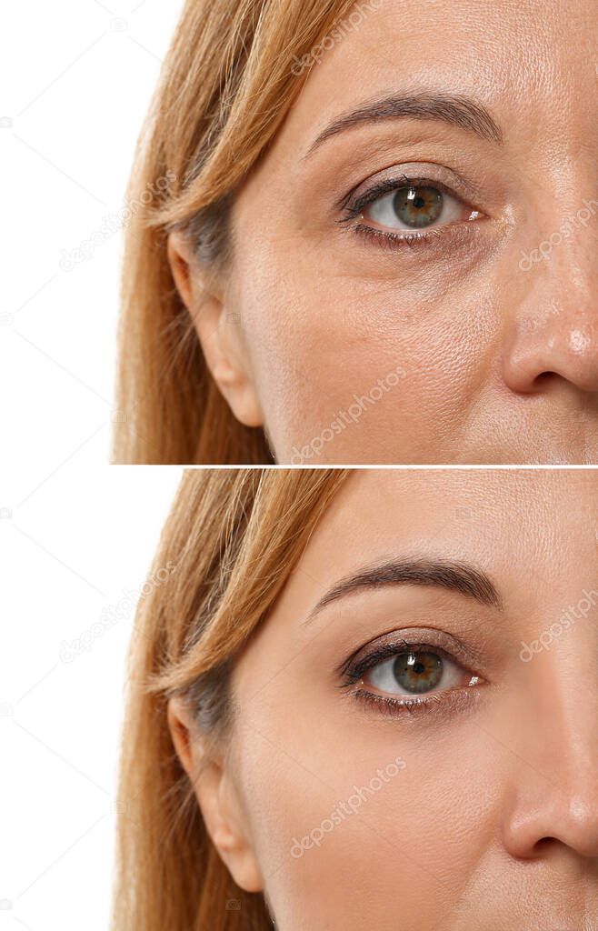 Woman before and after plastic surgery on white background, closeup