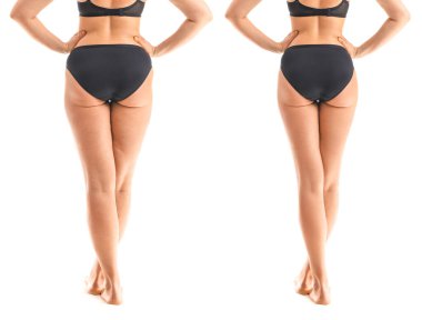 Beyaz arka planda anti-selülit tedavisi öncesi ve sonrası genç kadın