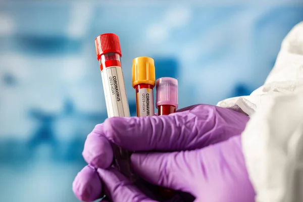 Covid Coronavirus Concept Doctor Lab Technician Holding Blood Sample — Stock Photo, Image
